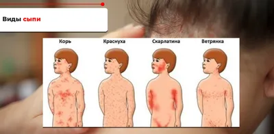 Пиодермия кожи головы: причины появления гнойников, лечение