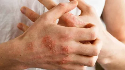 Вирусные инфекции которые влияют на кожу ребенка | PROMED