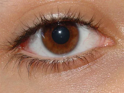 Покраснение века глаза: причины, диагностика и лечение