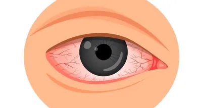 Как ревматоидный артрит может повлиять на глаза