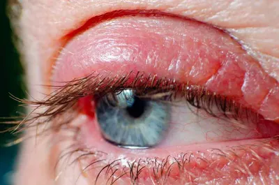 Красные глаза - почему возникает и как избавиться от покраснения глаз ᐉ  Сеть аптек «Бажаємо здоров'я»