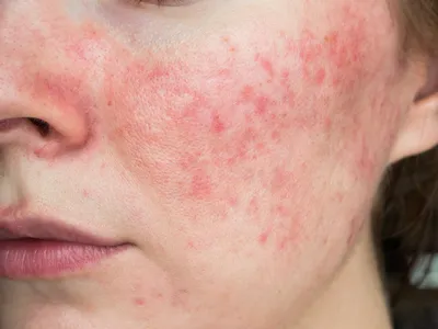 Инфекции кожи: что важно знать педиатру? | Ординаторская.онлайн |  Ординаторская онлайн