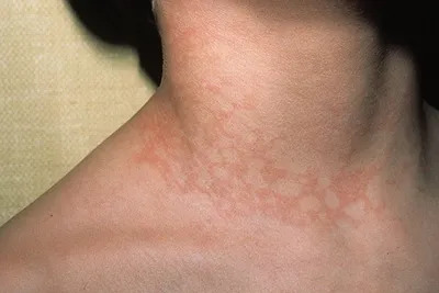 Инфекции кожи и мягких тканей | Козлов Р.С. | «РМЖ» №8 от 17.04.2014
