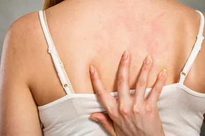 Микозы после отдыха: грибковые инфекции кожи и ногтей. | Медицинский центр  «Чистая Кожа» | Дзен