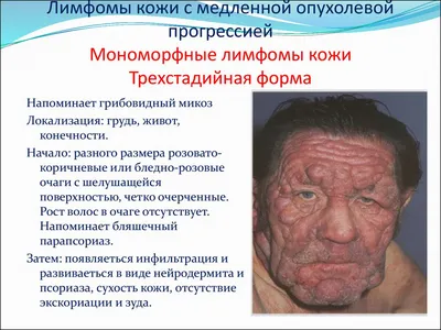 Вскрытие абсцессов кожи в Москве в Клинике подологии Полёт
