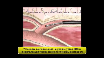 ICON инфильтрация кариеса у детей (лечение кариеса - «айкон») в СПб
