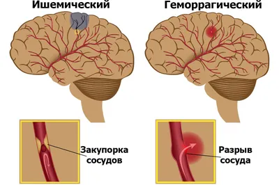 Двоение в глазах: причины и симптомы диплопии, способы лечения. - Всё о  зрении.