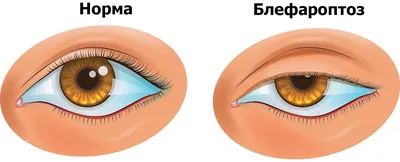 Инсульт и еще семь заболеваний, которые можно распознать по глазам