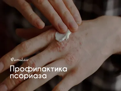 Медицинские мифы. Псориаз – экспертный материал, Lahta Clinic