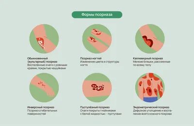 Псориаз (чешуйчатый лишай): симптомы, диагностика и лечение в клинике  Universum Clinic