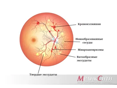 Увеиты (ирит, иридоциклит, хореоретинит): причины, диагностика, лечение