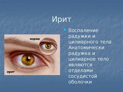 Какие виды ирита существуют и как его лечить? «Ochkov.net»