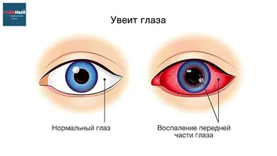 УВЕИТ ГЛАЗА. Острый Иридоциклит, ирит и хориоидит. Симптомы и лечение  увеита - YouTube