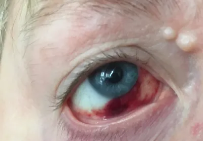 Травмы глаз: какие бывают, способы лечения - Офтальмологические клиники  «Эксимер» (Киев) – диагностика и лечение заболеваний глаз у взрослых и  детей Киев