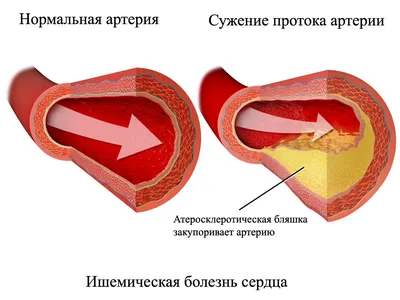 Ишемическая болезнь сердца: диагностика, лечение и профилактика - ГБУЗ ЯНАО