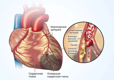 Лечение ишемической болезни сердца