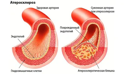 Ишемическая болезнь сердца – причины развития, симптомы и лечение — клиника  «Добробут»