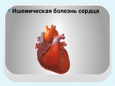 Ишемическая болезнь сердца: симптомы, риски. Лечение ИБС