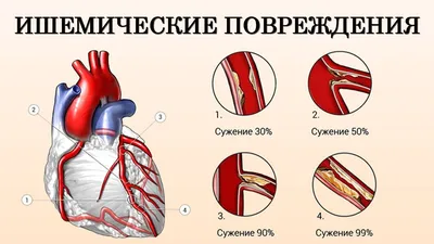 Особенности течения ишемической болезни сердца в сочетании с патологией  гастродуоденальной зоны (обзор литературы) – тема научной статьи по  клинической медицине читайте бесплатно текст научно-исследовательской  работы в электронной библиотеке КиберЛенинка