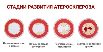 В КДЦ №1 пройдет занятие по теме «Ишемическая болезнь сердца»