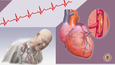 Ишемическая болезнь сердца и стенокардия - причины развития, симптомы,  лечение