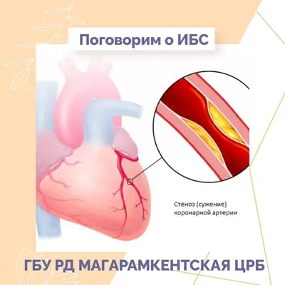 ИШЕМИЧЕСКАЯ БОЛЕЗНЬ СЕРДЦА И СТЕНОКАРДИЯ – тема научной статьи по  клинической медицине читайте бесплатно текст научно-исследовательской  работы в электронной библиотеке КиберЛенинка