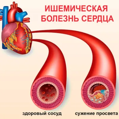 Ишемическая болезнь сердца :: Администрация Крымского района