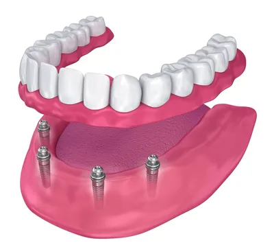 Имплантация съемных зубов - Cтоматология Май