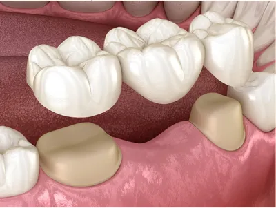 Anis EXPERT Фронтальные верхние Акриловые зубы (размер 53 цвет C2) UP53C2 —  Dentburg