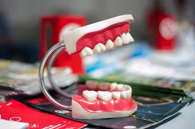 Виды протезирования зубов, какой зубной протез выбрать? - Статьи