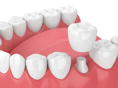 Какими бывают искусственные зубы? | Стоматология Королевская улыбка | Дзен