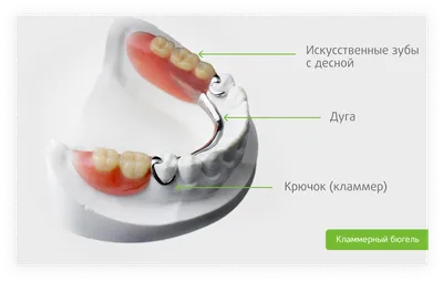 Съемные зубные протезы: какие лучше, виды, преимущества, методы  протезирования, особенности