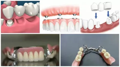 Искусственные зубы из смолы | AliExpress