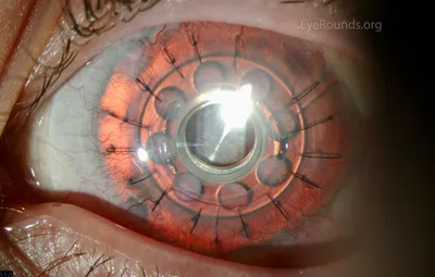Слепому человеку вернули зрение с помощью искусственной детали для глаза —  Ferra.ru