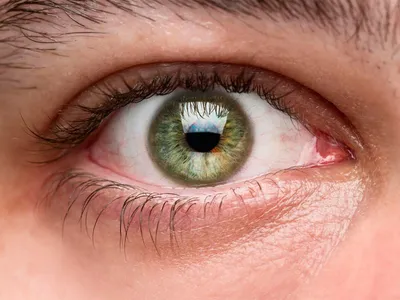 Имплантация искусственного хрусталика - метод лечения катаракты | World  Vision Clinic