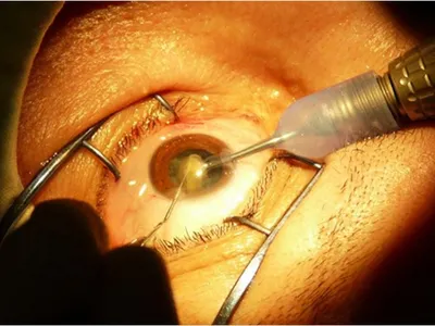 Сверхтонкие искусственные хрусталики глаза впервые в регионе имплантировали  офтальмологи | Информационное агентство «Время Н»