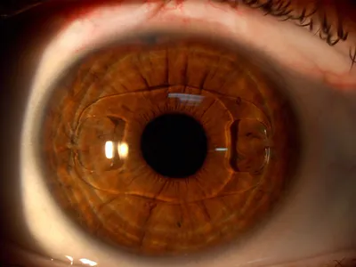 Искусственный хрусталик глаза — SU 1380743