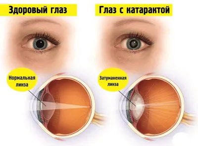 Хирургия катаракты