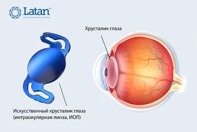 Замена прозрачного хрусталика. Лечение катаракты, имплантация искусственного  хрусталика. Замена прозрачного хрусталика. Имплантация факичных линз. МНТК  \"Микрохирургия глаза\"