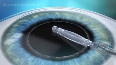 Хрусталик глаза искусственный Т-19 переднекамерный составной ПММА 5 мм
