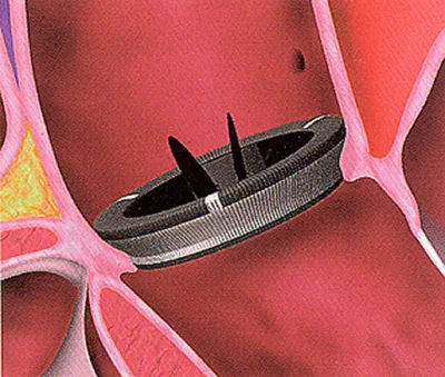 Файл:MKCH-01 artificial heart valve.jpg — Википедия