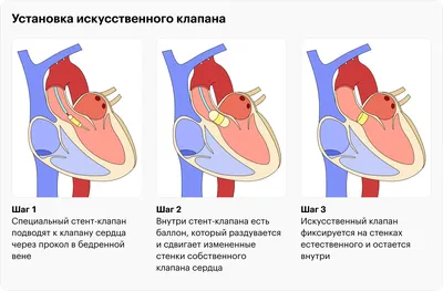 Искусственный клапан сердца - В операционной - ARCHIBASOV - Участники -  Фотогалерея iXBT
