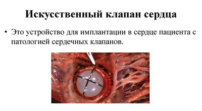 Искусственный клапан сердца — 30.04.2013 — U 9164 — База патентов Беларуси