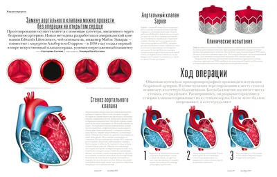 Сердечно-сосудистая система. Искусственные клапаны сердца - online  presentation