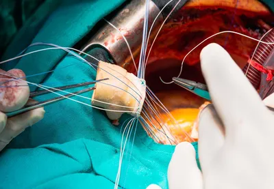 Замену аортального клапана можно провести без операции на открытом сердце –  Наука – Коммерсантъ