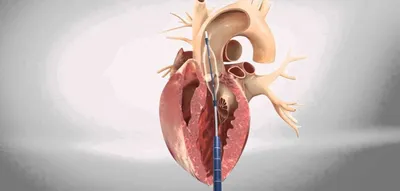 Нейросеть предскажет лучшее место для установки искусственного клапана в  сердце