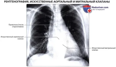 Протезирование клапанов сердца в Беларуси Минск