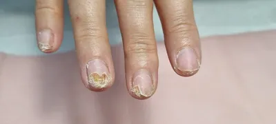 Испорченные ногти после гель лака фото фото