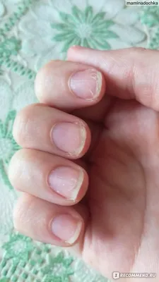 Отзыв о Интенсивное ухаживающее и восстанавливающее покрытие для сильно  поврежденных ногтей Nano Shark Emergency | Как быстро восстановить ногти  после гель-лака (фото ДО и ПОСЛЕ)