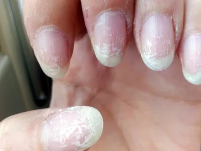 5 лет я без перерыва наращивала ногти и делала гель-лак. Покажу как  выглядят ногти после снятия покрытия | Космо ЁЖ | Дзен